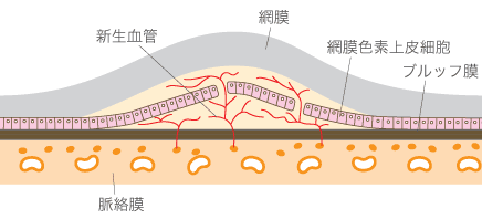 加齢黄斑変性　イメージ図